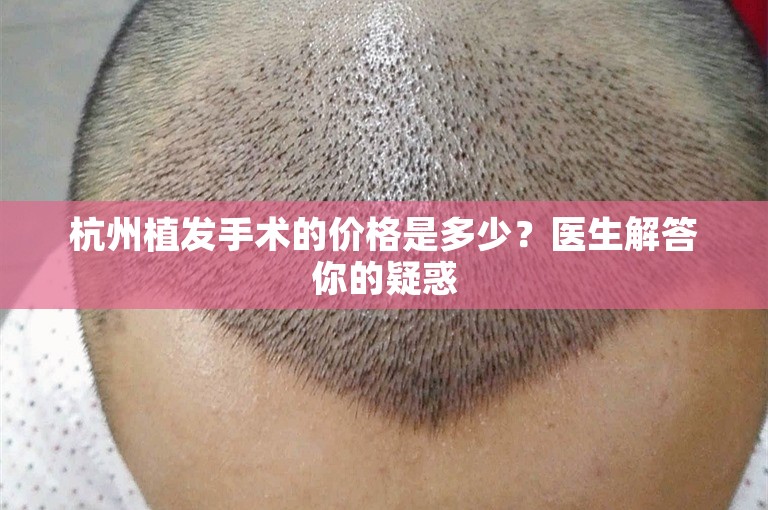 杭州植发手术的价格是多少？医生解答你的疑惑