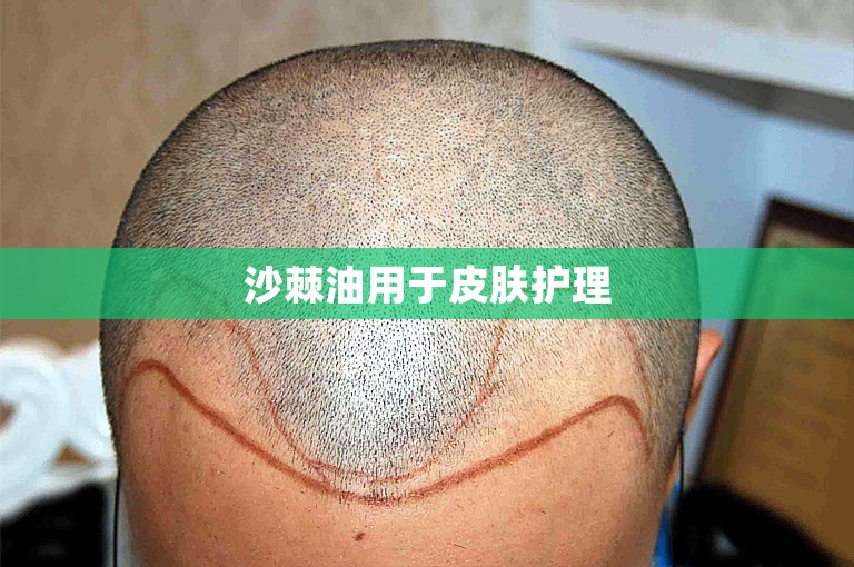 湘潭市做植发手术大概需要多少费用