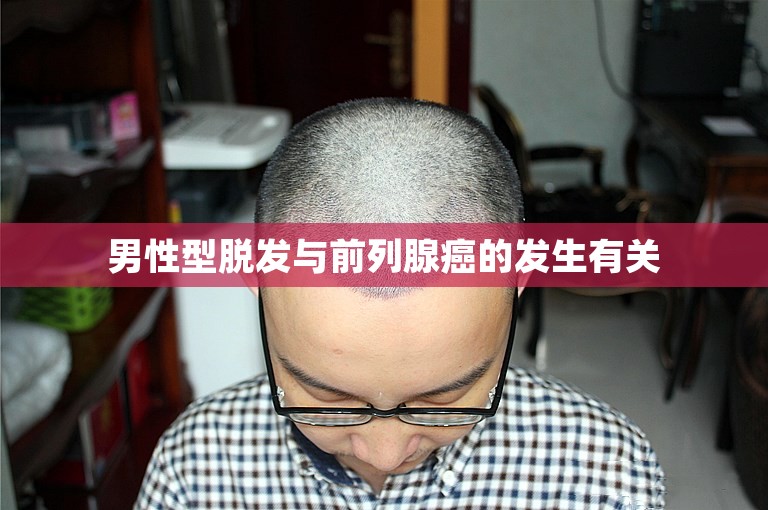 男性型脱发与前列腺癌的发生有关