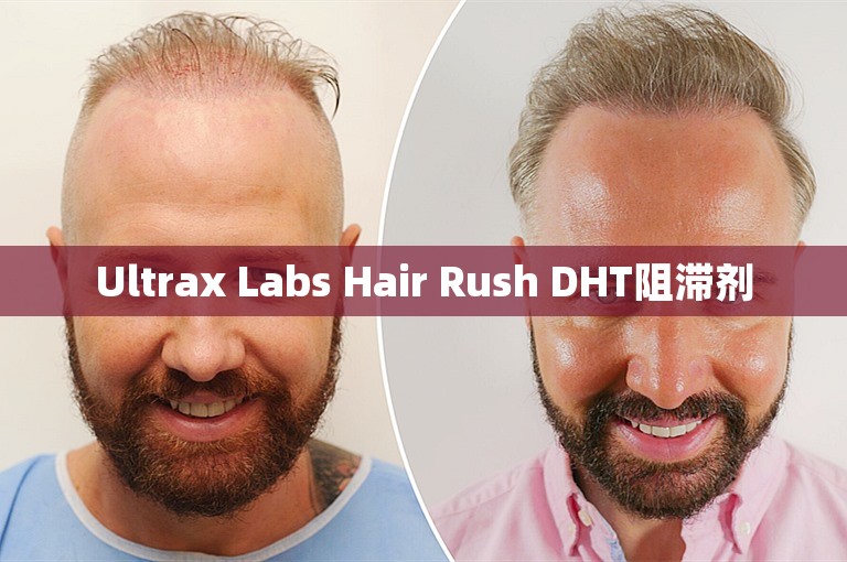 Ultrax Labs Hair Rush DHT阻滞剂