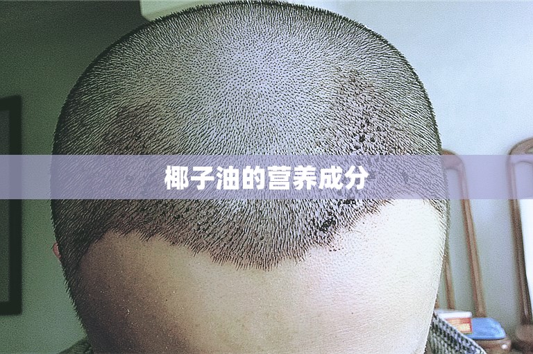 我也犯迷糊：惠州秃顶植发一般多少钱？