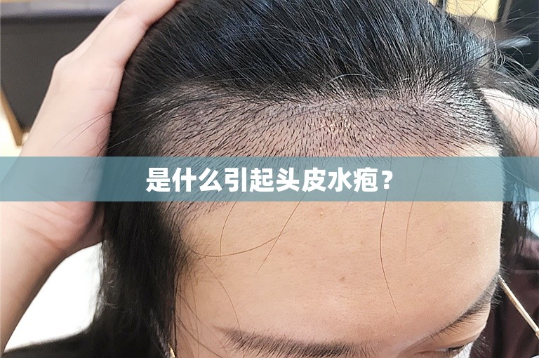 针对脱发问题，西安植发需要多少费用？