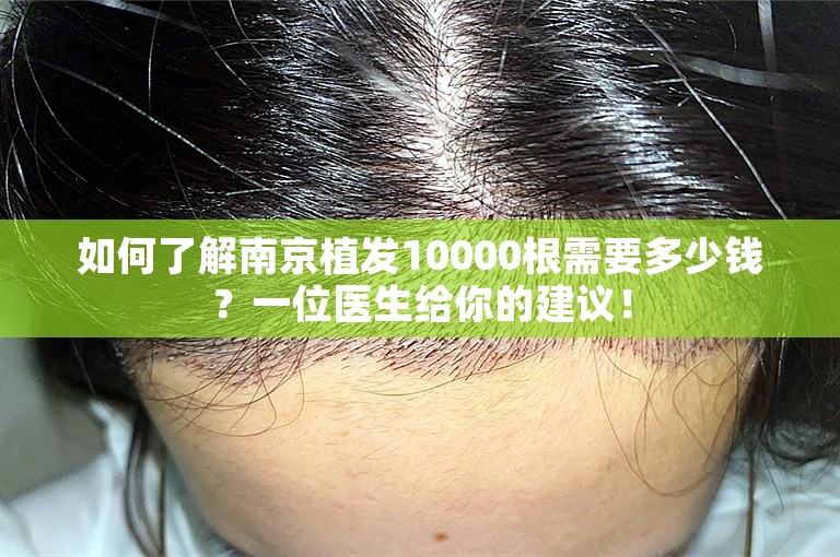 如何了解南京植发10000根需要多少钱？一位医生给你的建议！