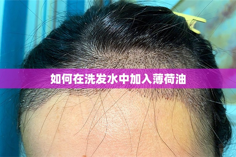 从医生的角度看杭州新生植发2000毛囊单位多少钱？