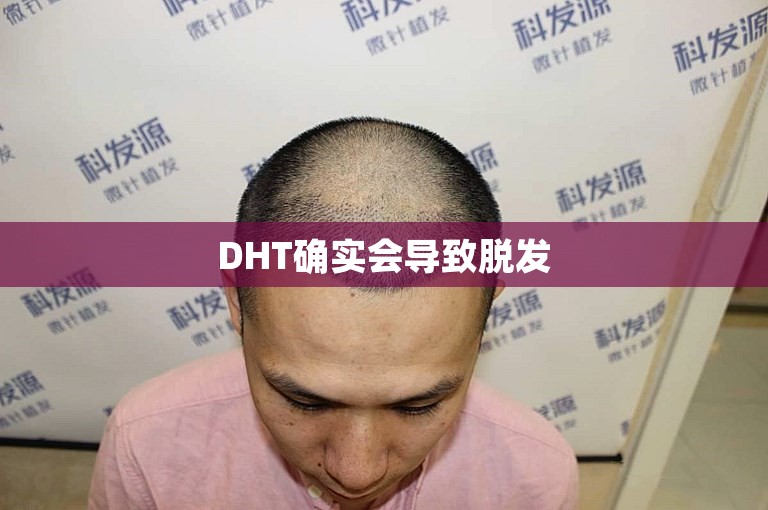 DHT确实会导致脱发