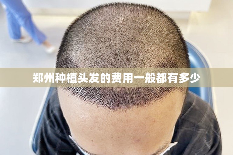 郑州种植头发的费用一般都有多少