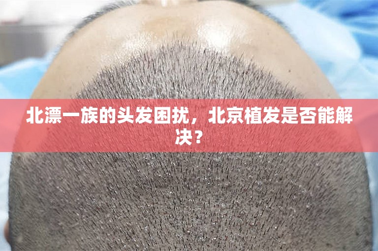 北漂一族的头发困扰，北京植发是否能解决？