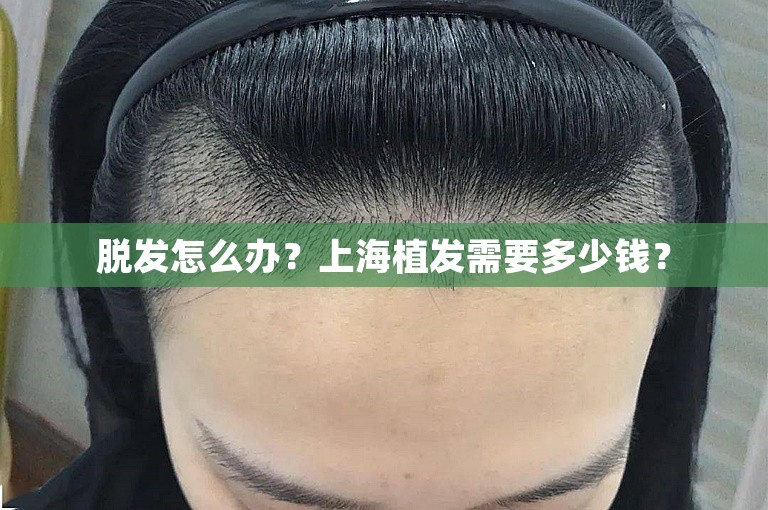 脱发怎么办？上海植发需要多少钱？