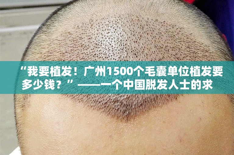 “我要植发！广州1500个毛囊单位植发要多少钱？”——一个中国脱发人士的求救