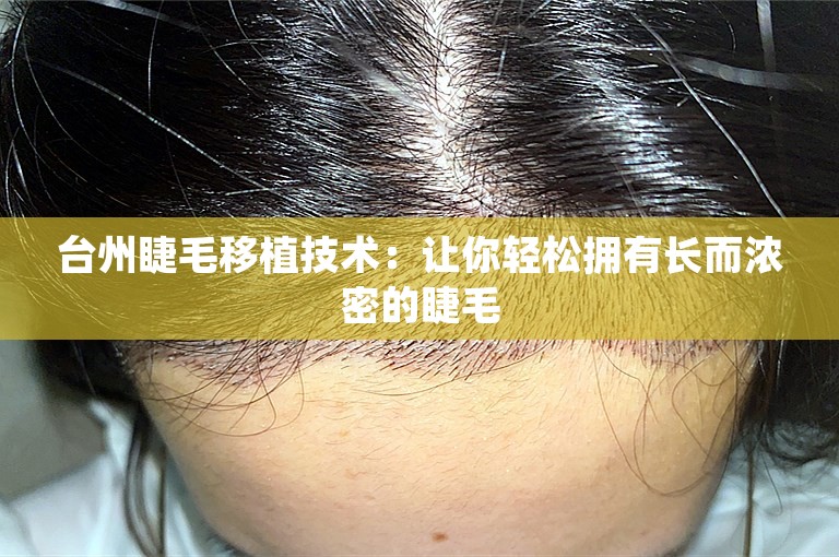 台州睫毛移植技术：让你轻松拥有长而浓密的睫毛
