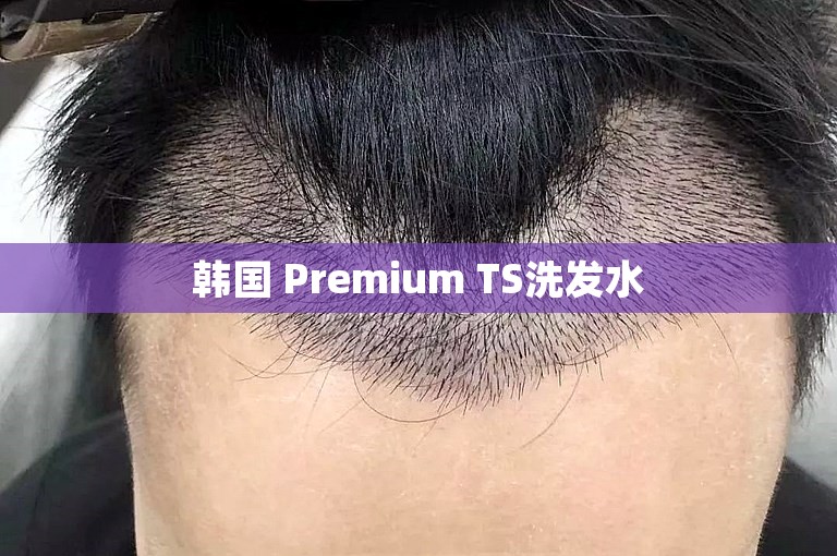 头发有救！中国脱发人士经历及解决方法