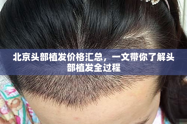 北京头部植发价格汇总，一文带你了解头部植发全过程