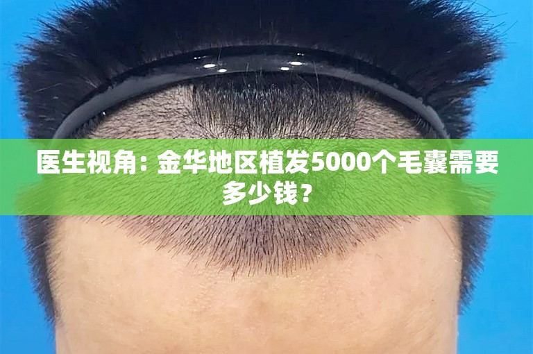 医生视角: 金华地区植发5000个毛囊需要多少钱？
