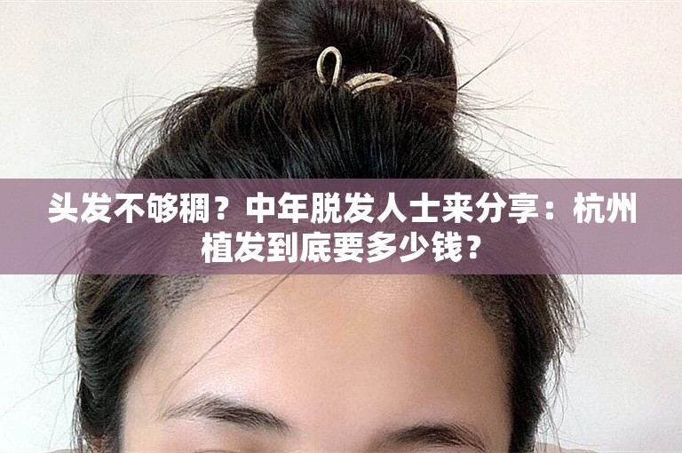 头发不够稠？中年脱发人士来分享：杭州植发到底要多少钱？