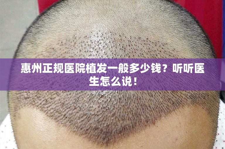 惠州正规医院植发一般多少钱？听听医生怎么说！