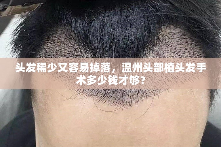 头发稀少又容易掉落，温州头部植头发手术多少钱才够？