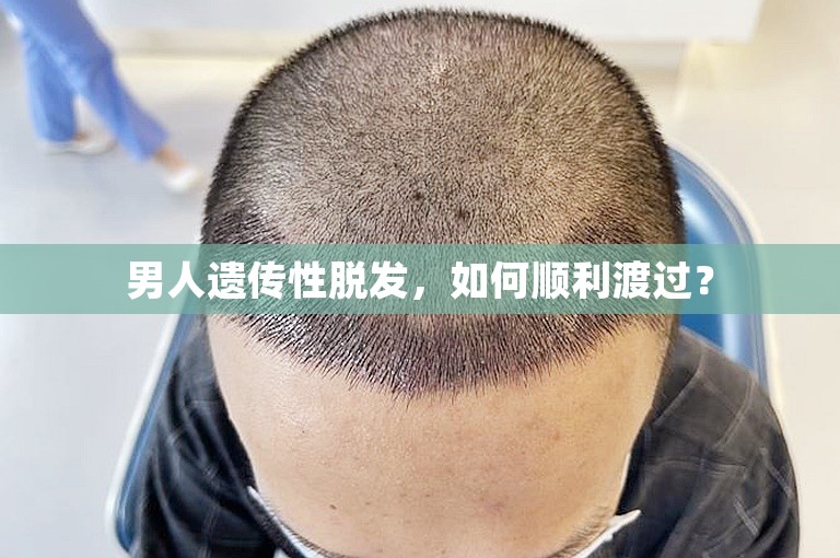 男人遗传性脱发，如何顺利渡过？