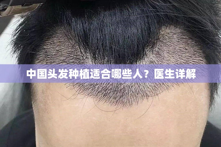 中国头发种植适合哪些人？医生详解