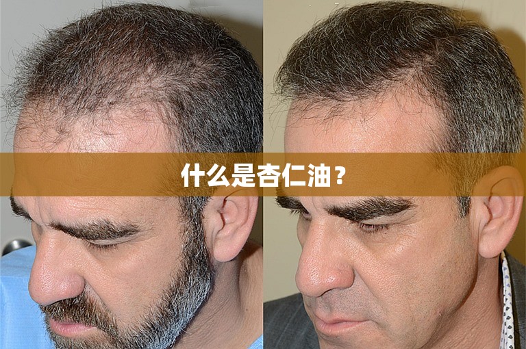 北京种植额角毛发需要多少钱？