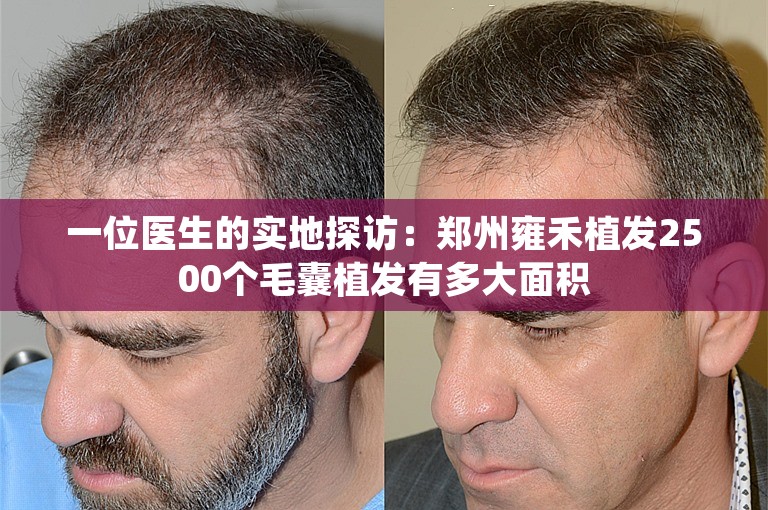 一位医生的实地探访：郑州雍禾植发2500个毛囊植发有多大面积