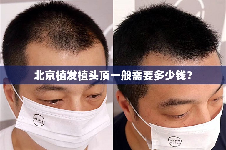 北京植发植头顶一般需要多少钱？