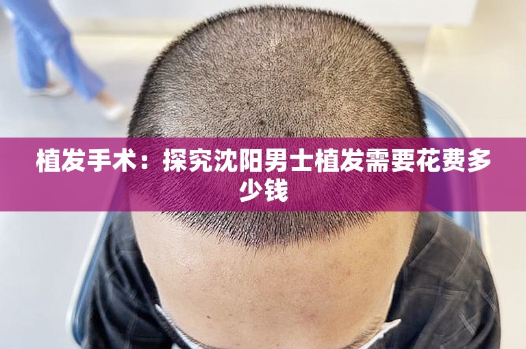 植发手术：探究沈阳男士植发需要花费多少钱