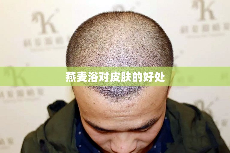 为什么越来越多的人选择杭州m型发际线植发？