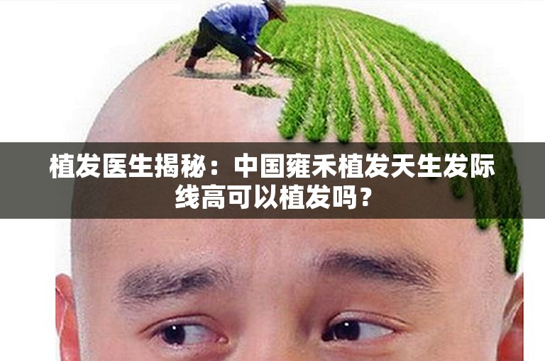 植发医生揭秘：中国雍禾植发天生发际线高可以植发吗？