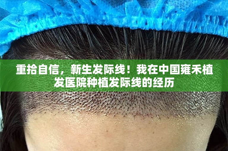 重拾自信，新生发际线！我在中国雍禾植发医院种植发际线的经历