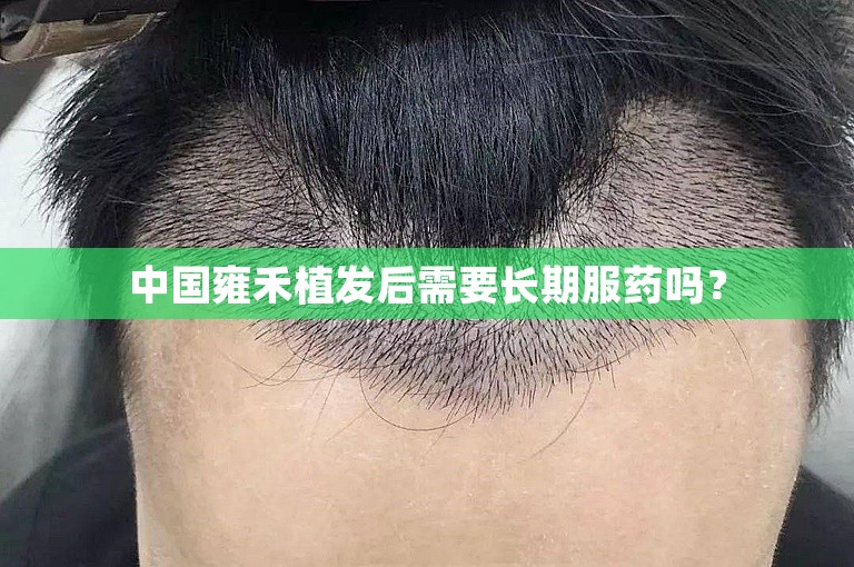 中国雍禾植发后需要长期服药吗？