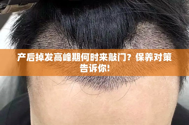 广州植发头顶一般多少钱