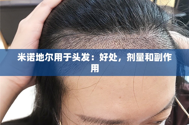 米诺地尔用于头发：好处，剂量和副作用