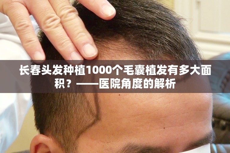 长春头发种植1000个毛囊植发有多大面积？——医院角度的解析