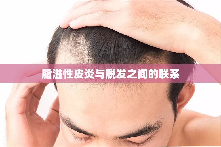 脂溢性皮炎与脱发之间的联系