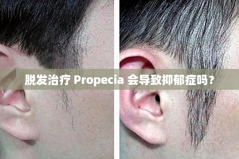 脱发治疗 Propecia 会导致抑郁症吗？