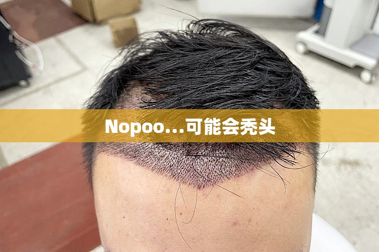 Nopoo...可能会秃头