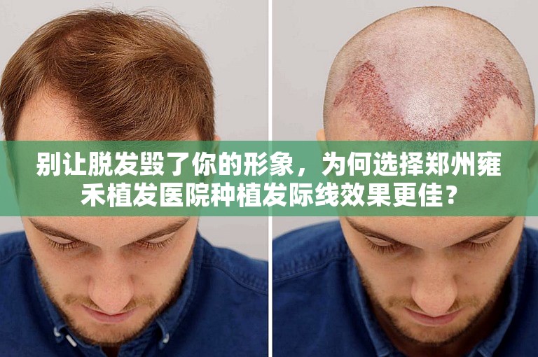 别让脱发毁了你的形象，为何选择郑州雍禾植发医院种植发际线效果更佳？