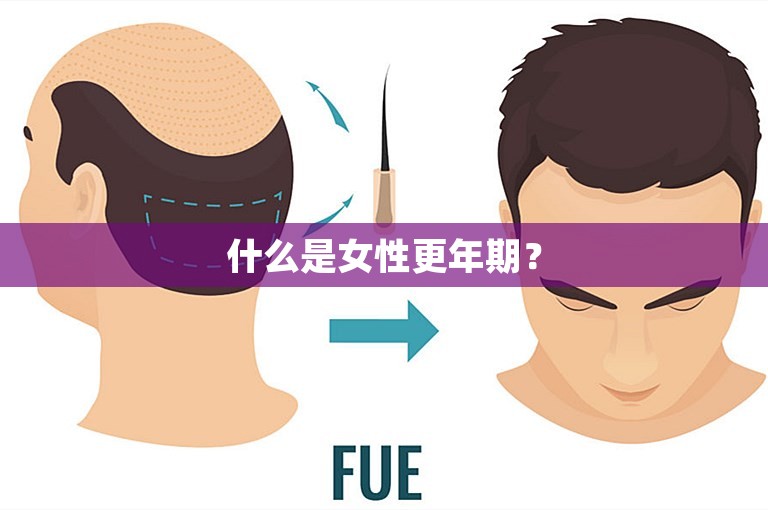 广州新生NOCUT不剃发植发女性发缝加密多少钱？