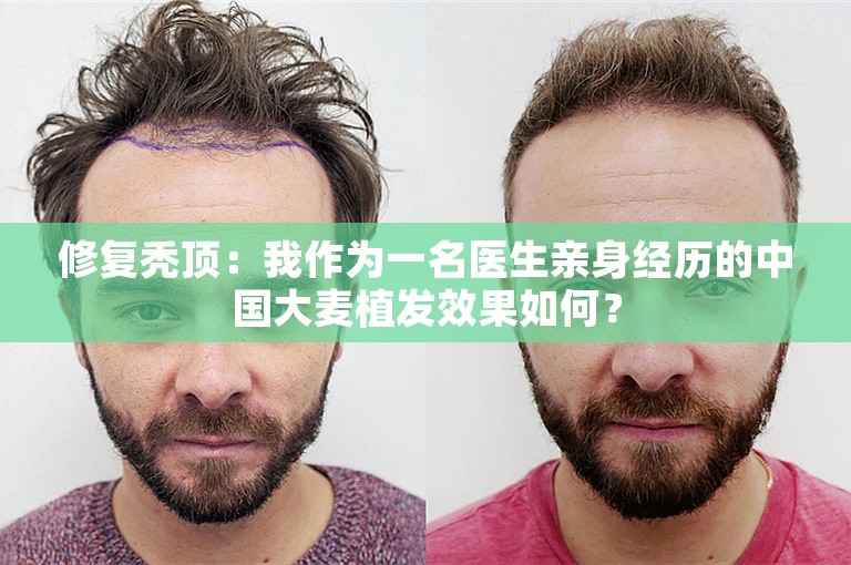 修复秃顶：我作为一名医生亲身经历的中国大麦植发效果如何？