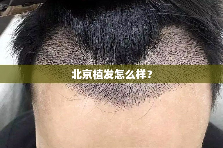 北京植发怎么样？