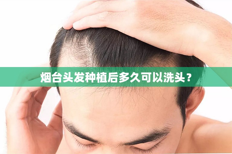 烟台头发种植后多久可以洗头？
