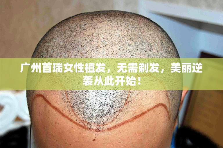 广州首瑞女性植发，无需剃发，美丽逆袭从此开始！