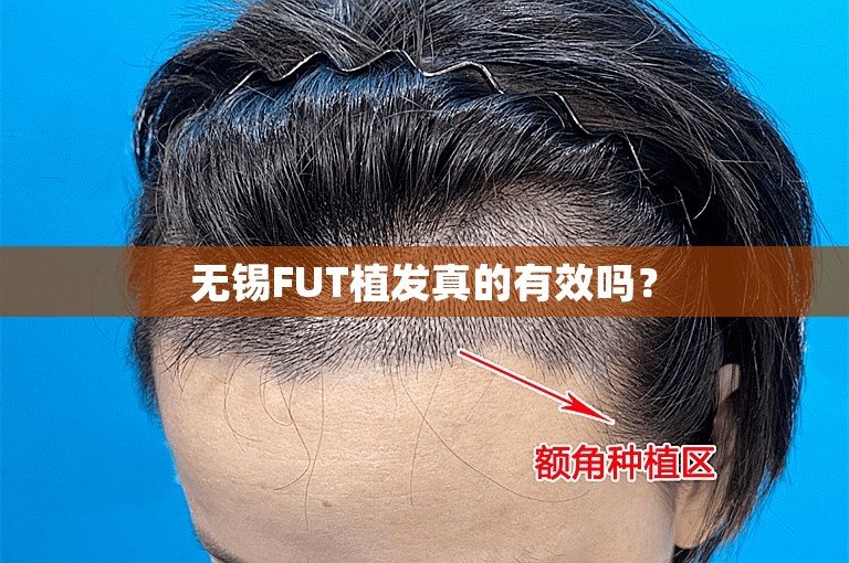 无锡FUT植发真的有效吗？