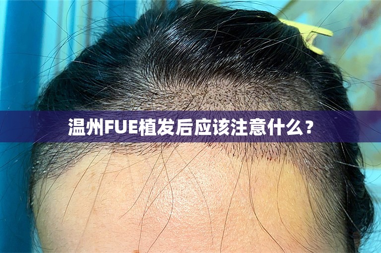 温州FUE植发后应该注意什么？