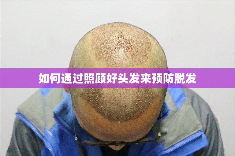 台州头顶植发大概需要多少钱