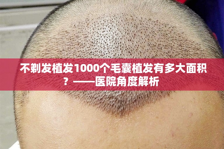  不剃发植发1000个毛囊植发有多大面积？——医院角度解析 