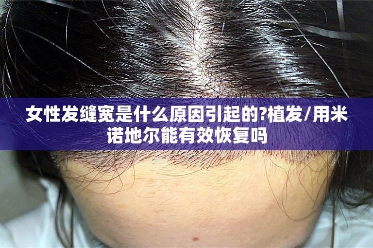 女性发缝宽是什么原因引起的?植发/用米诺地尔能有效恢复吗