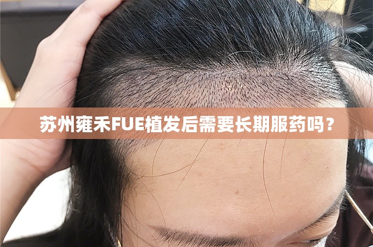 苏州雍禾FUE植发后需要长期服药吗？