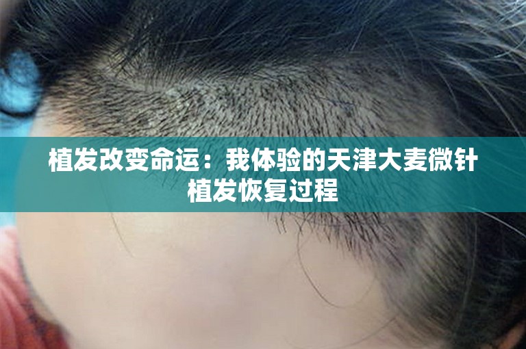 植发改变命运：我体验的天津大麦微针植发恢复过程