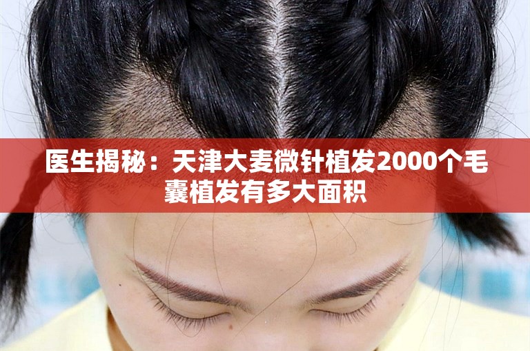 医生揭秘：天津大麦微针植发2000个毛囊植发有多大面积